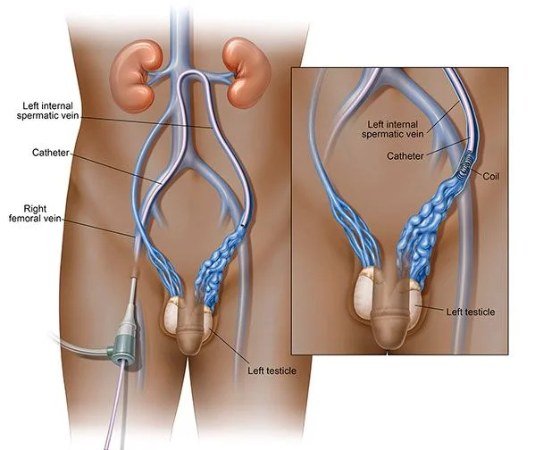 Varicocele anatomy diagram showing enlarged testicular veins